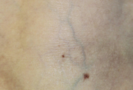 image of client after using laser vein treatment