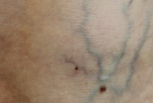 image of client before using laser vein treatment