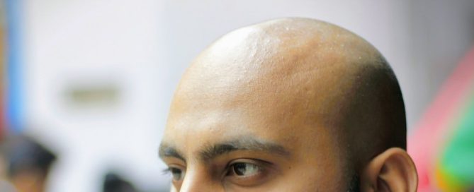 Treatment Options for Early Signs of Balding